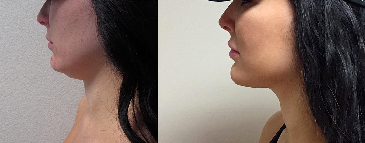 Neck Lift Before & After