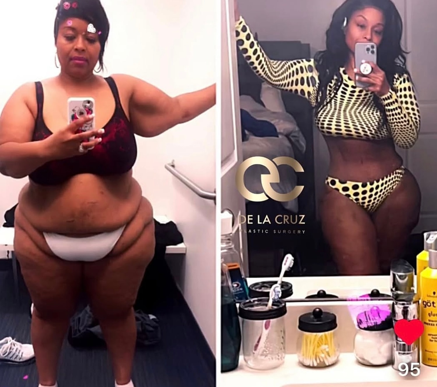 large volume liposuction before after Houston