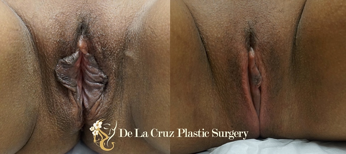 Labiaplasty Before & After