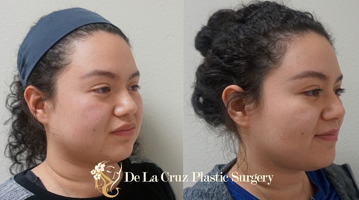 Buccal Fat Removal Before & After