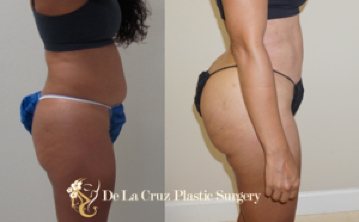 Brazilian Butt Lift Before & After