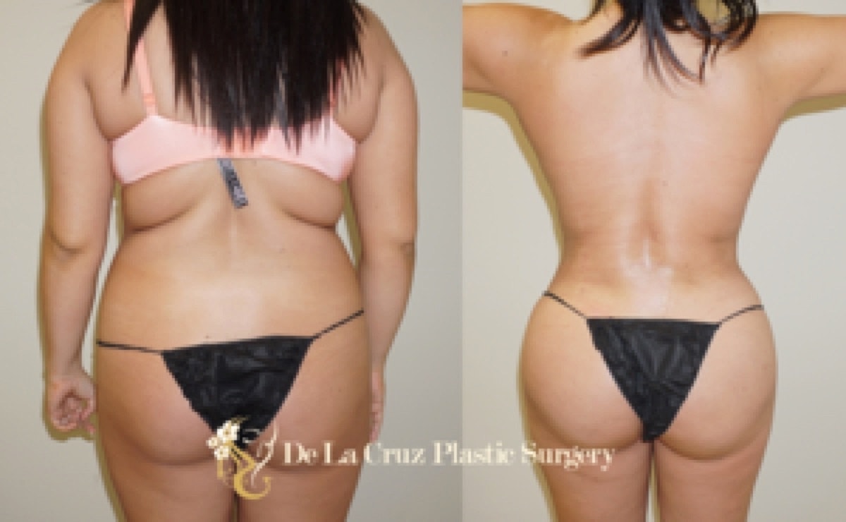 Brazilian Butt Lift Before & After