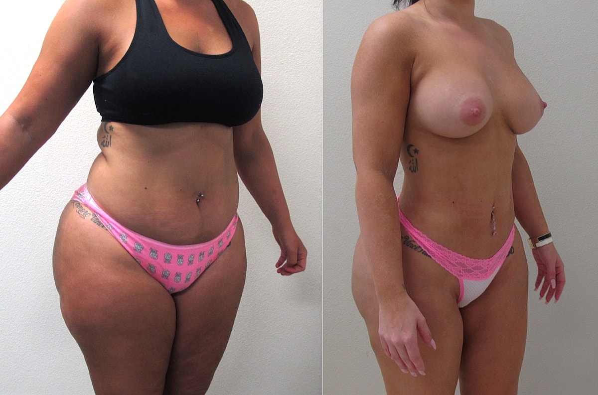 Brazilian Butt Lift Before & After