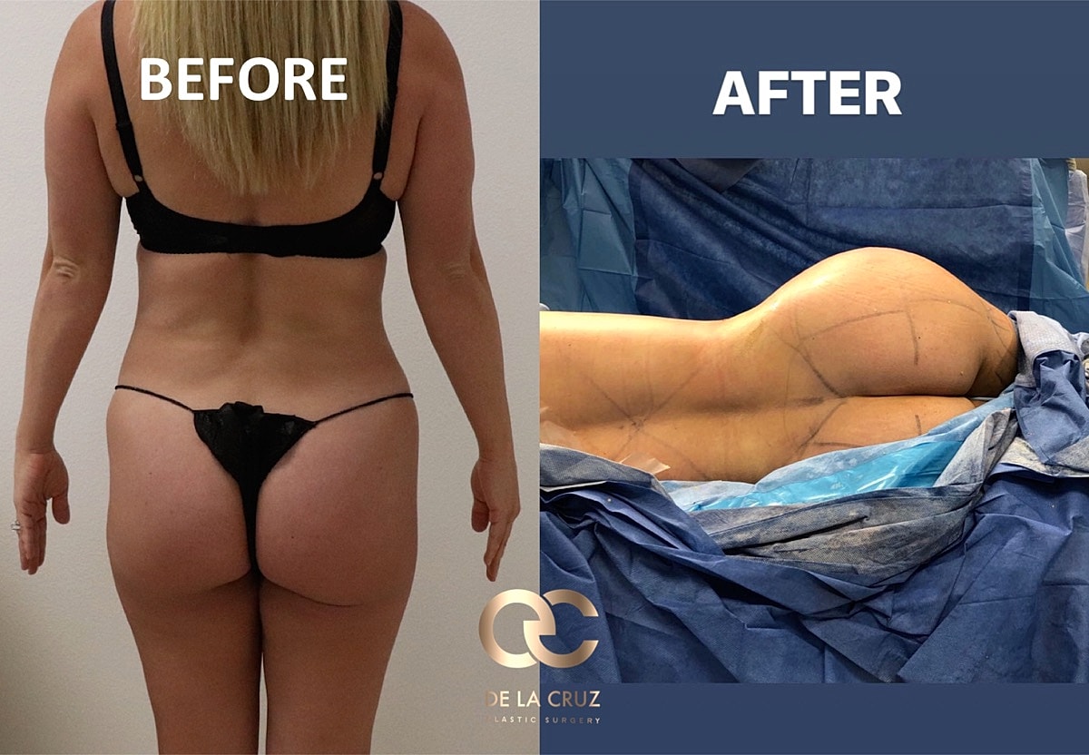 Brazilian Butt Lift Before & After