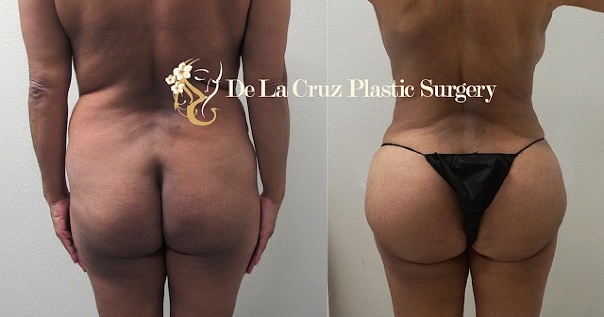 Brazilian Butt Lift Before & After