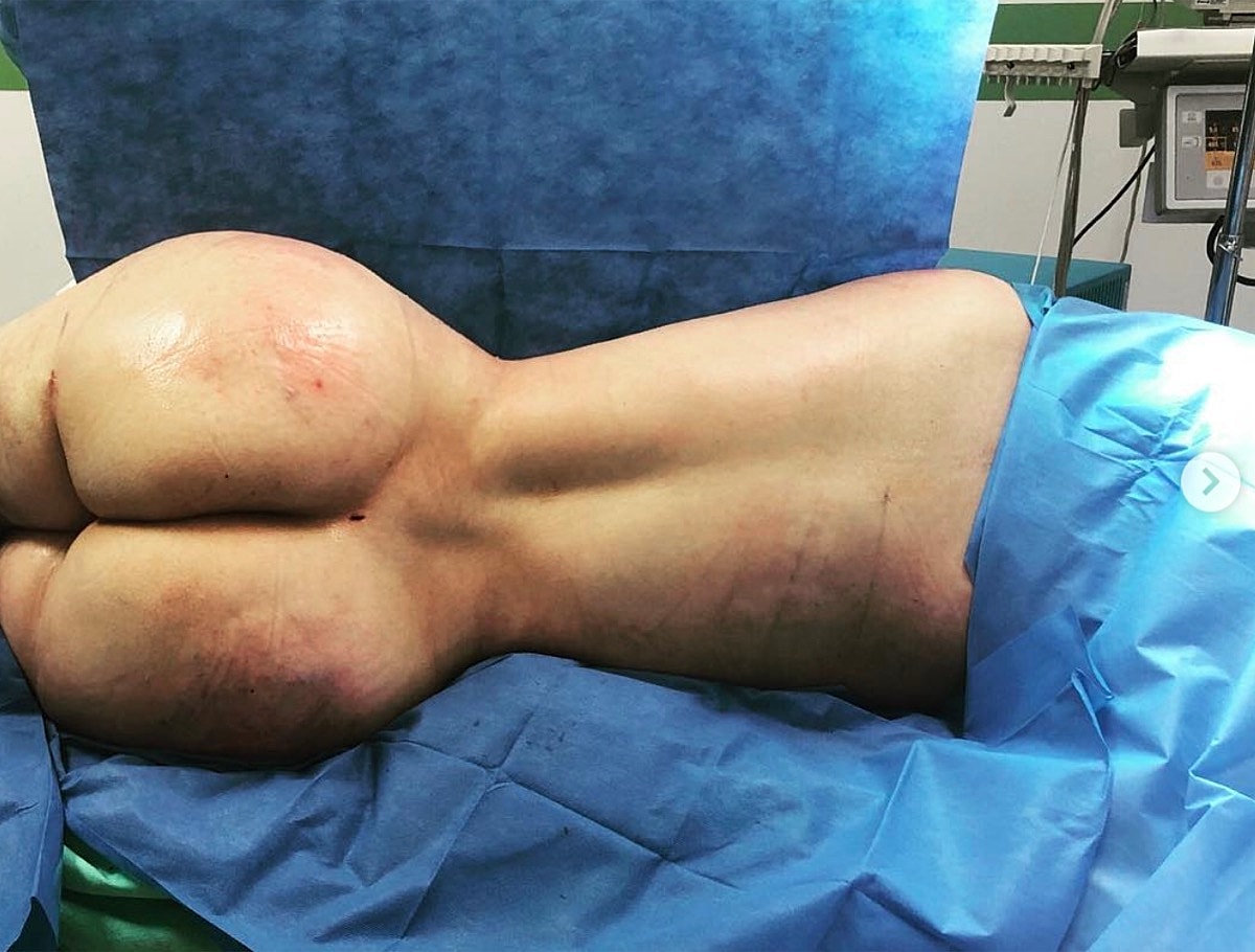 Brazilian Butt Lift Before & After