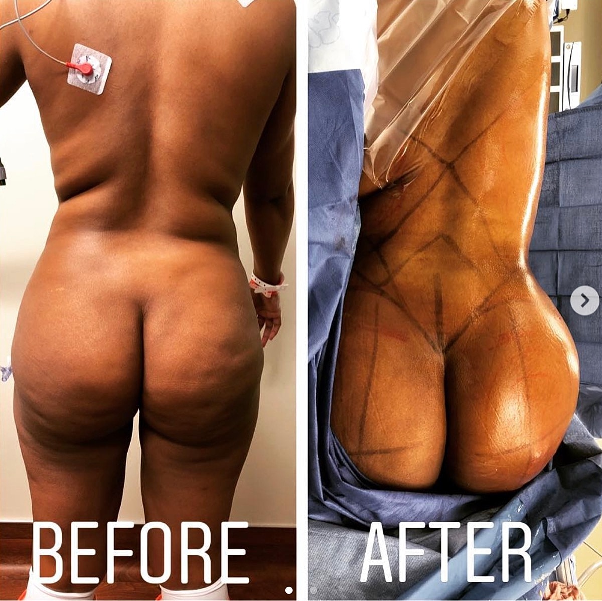 Brazilian Butt Lift Before & After