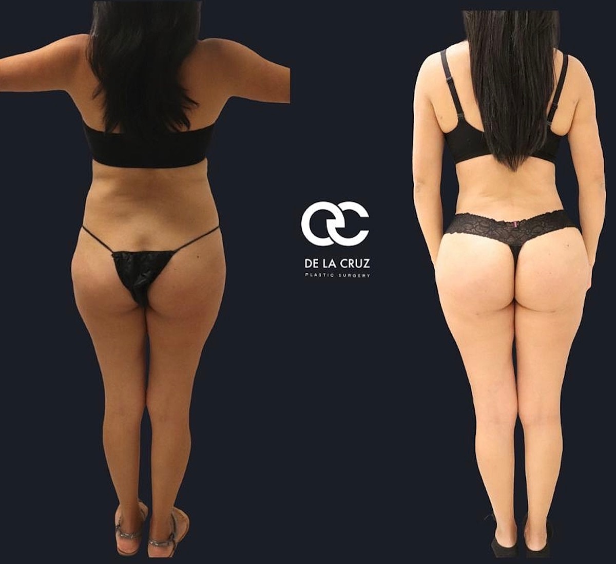 Brazilian Butt Lift Before & After
