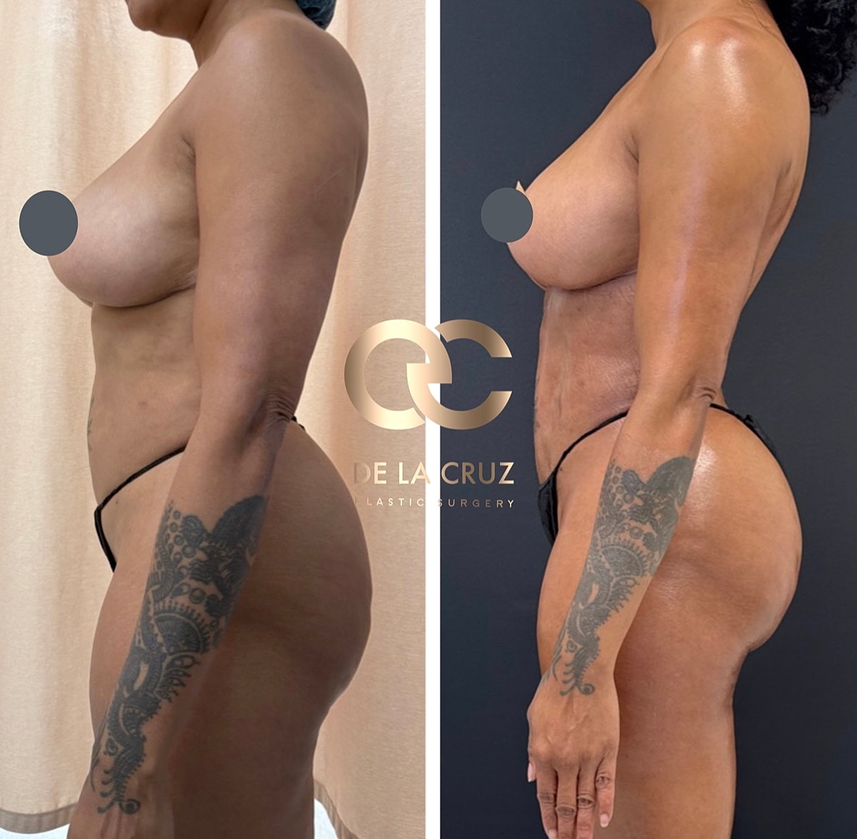 Brazilian Butt Lift Before & After