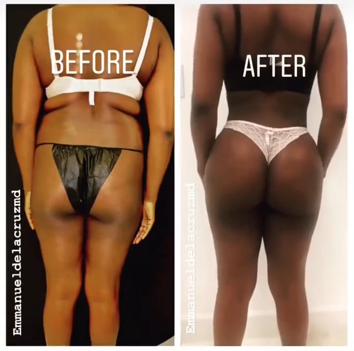 Brazilian Butt Lift Before & After