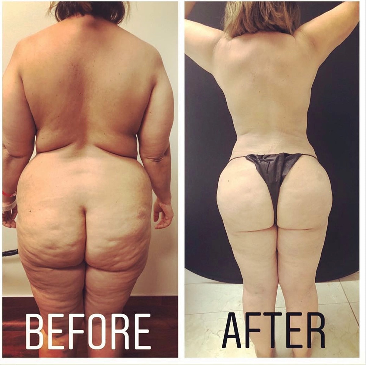 Large Volume High Def Liposuction Before & After