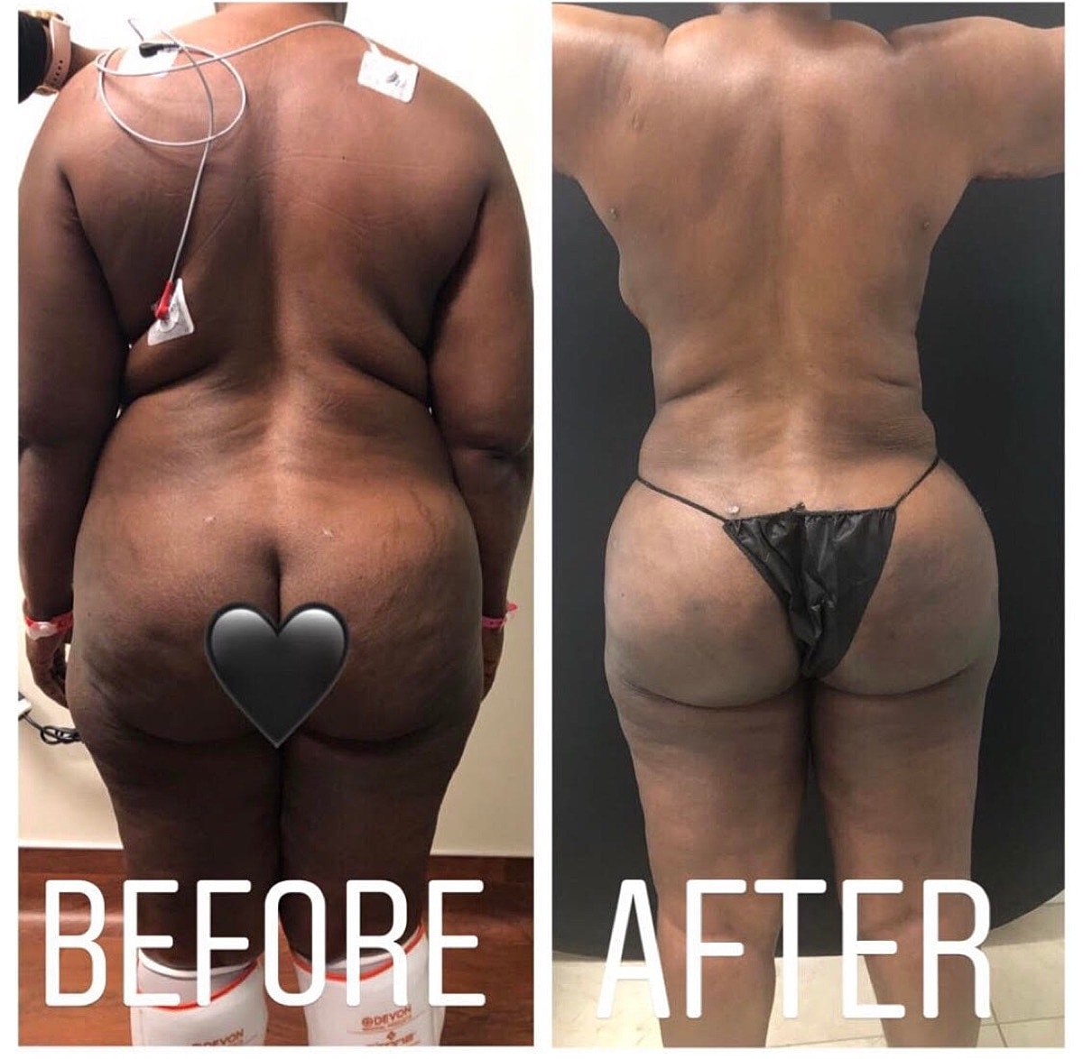 Large Volume High Def Liposuction Before & After