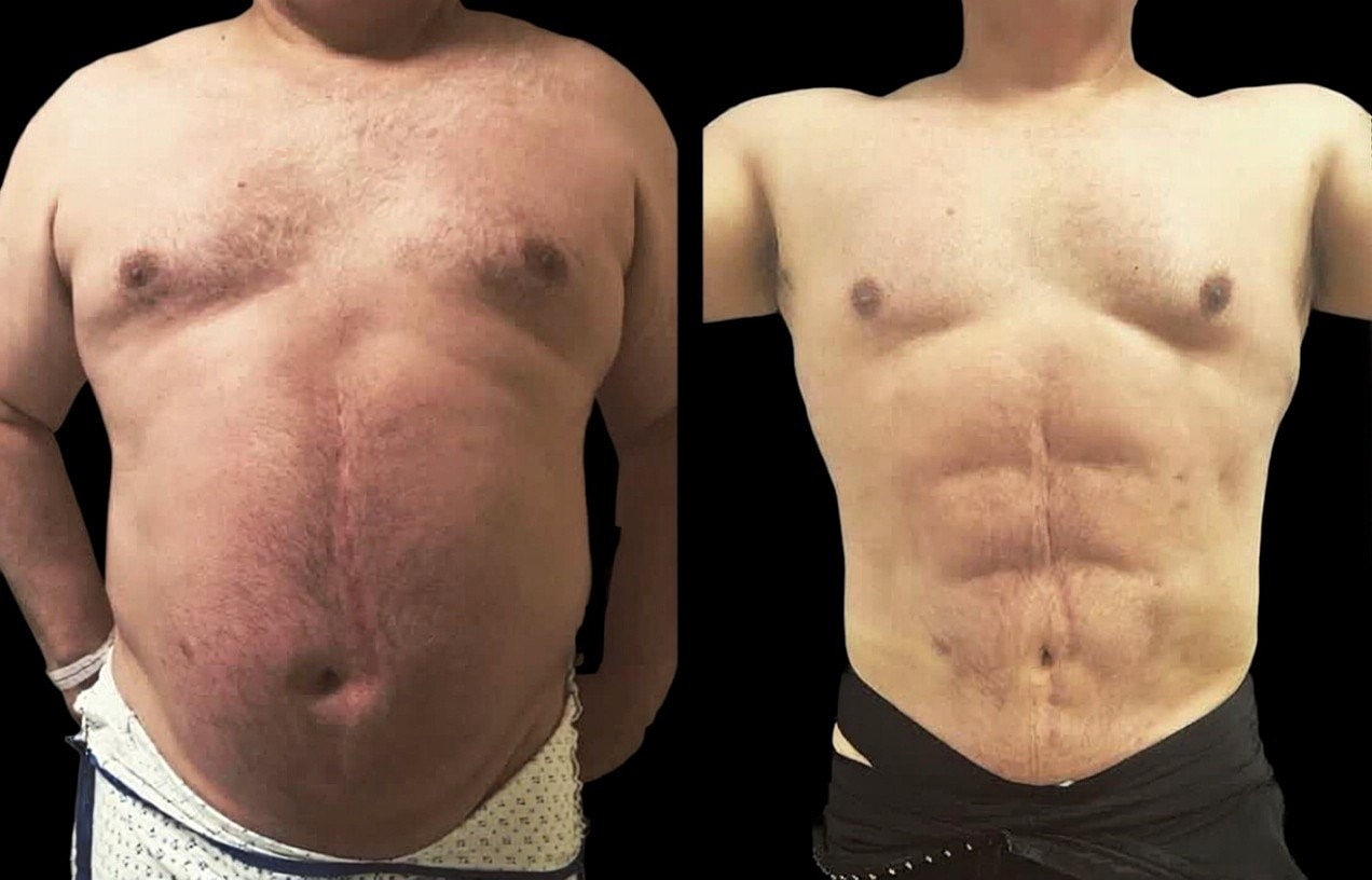 Before and after body transformation comparison.