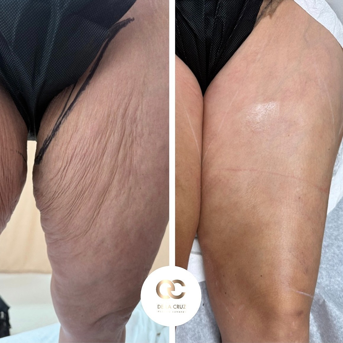 revision liposuction houston contour irregularities correction vaser quantum rf morpheus8 medial thigh lift