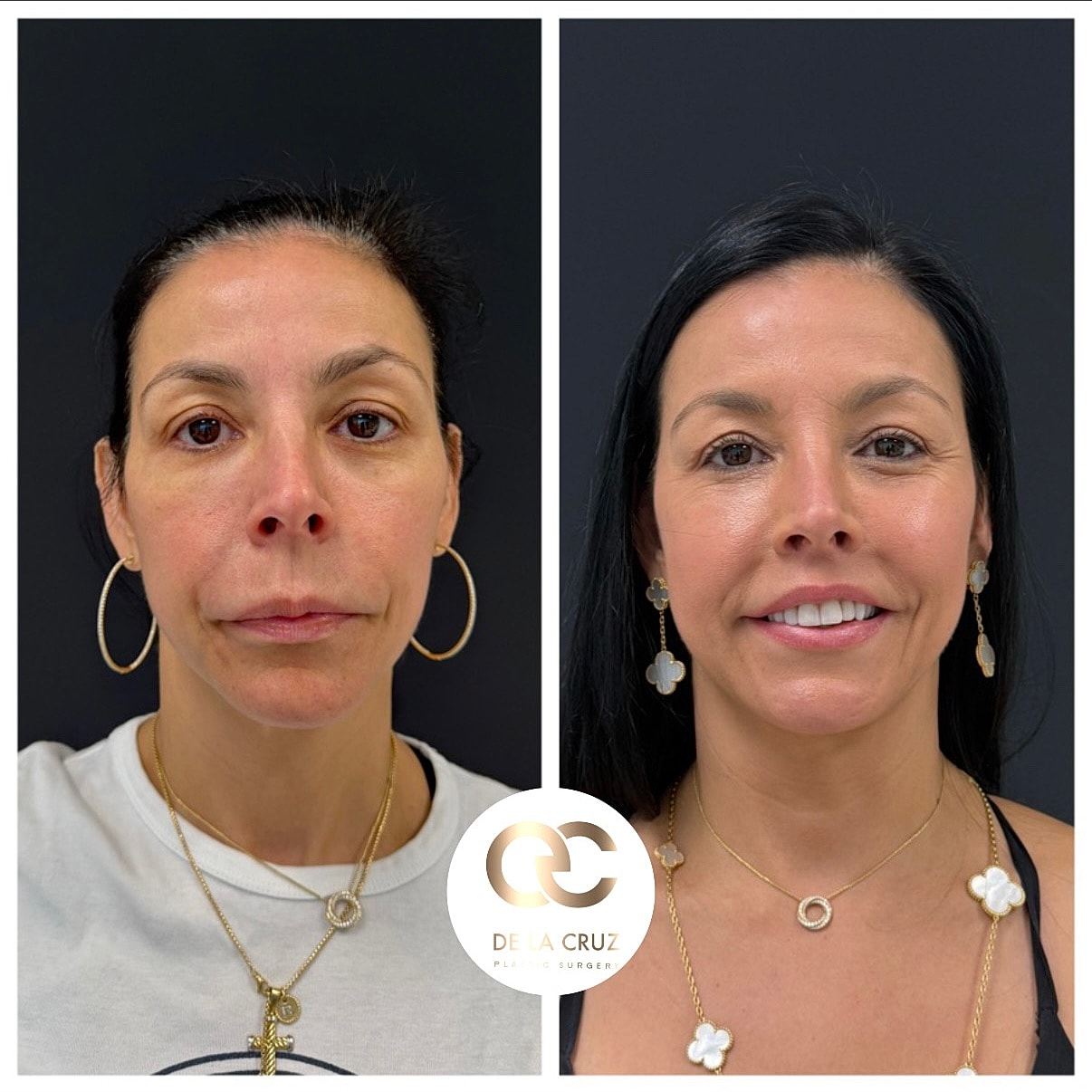 Before and after cosmetic transformation comparison.