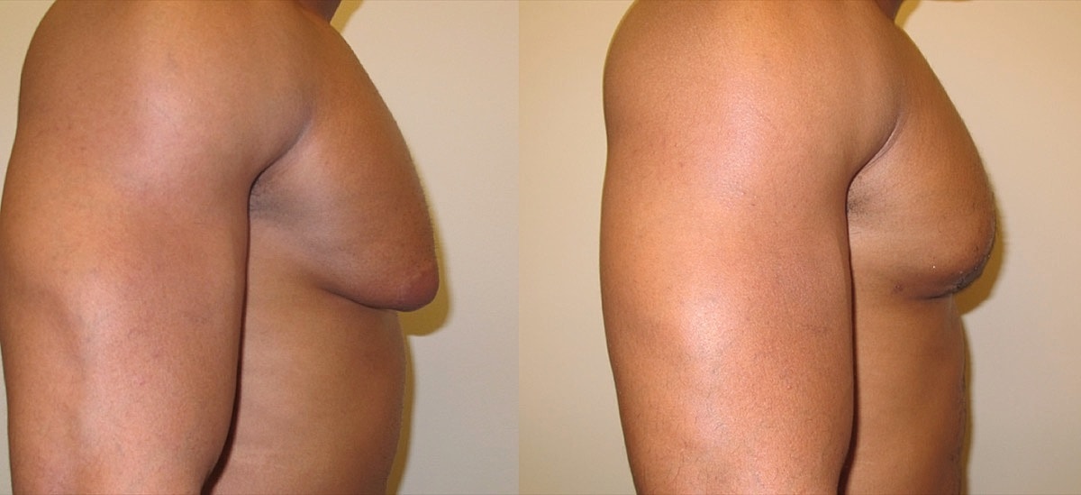 Gynecomastia Surgery Before & After