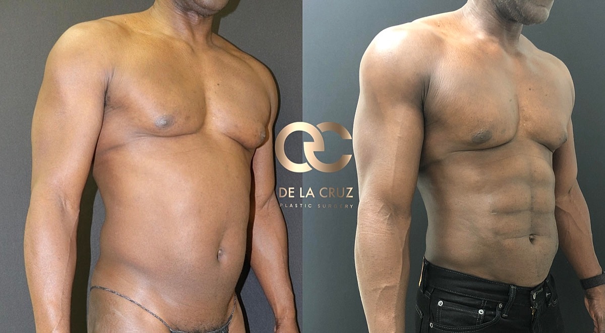 4d Vaser Liposuction For Men Before & After