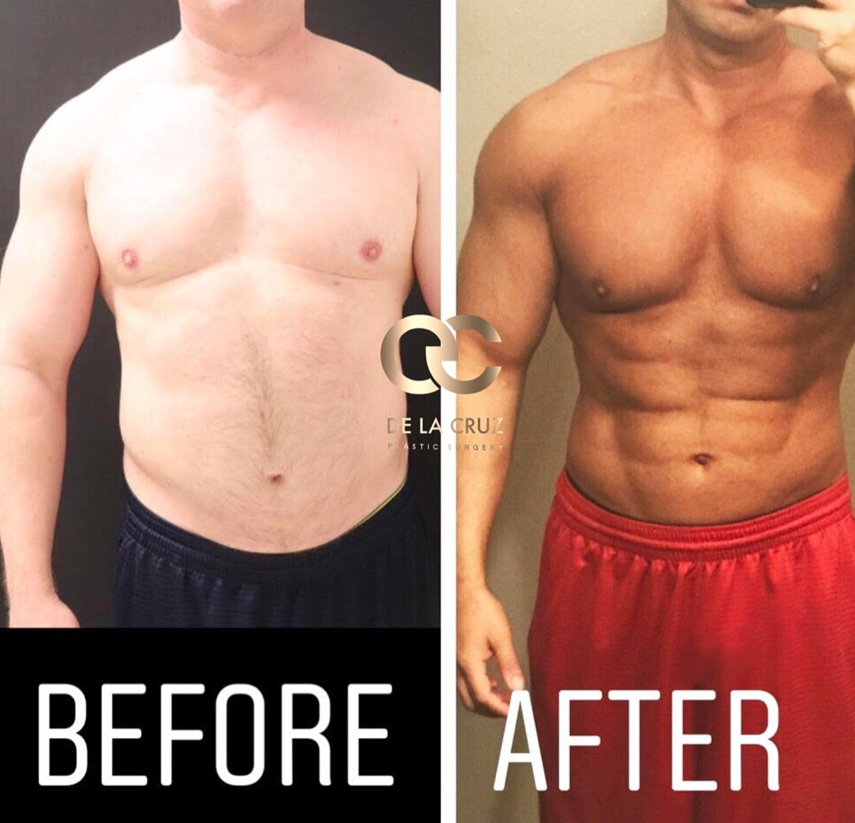 4d Vaser Liposuction For Men Before & After