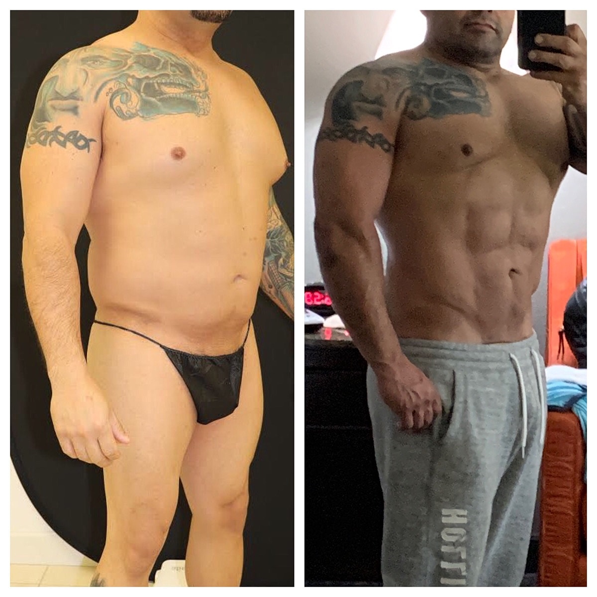 4d Vaser Liposuction For Men Before & After