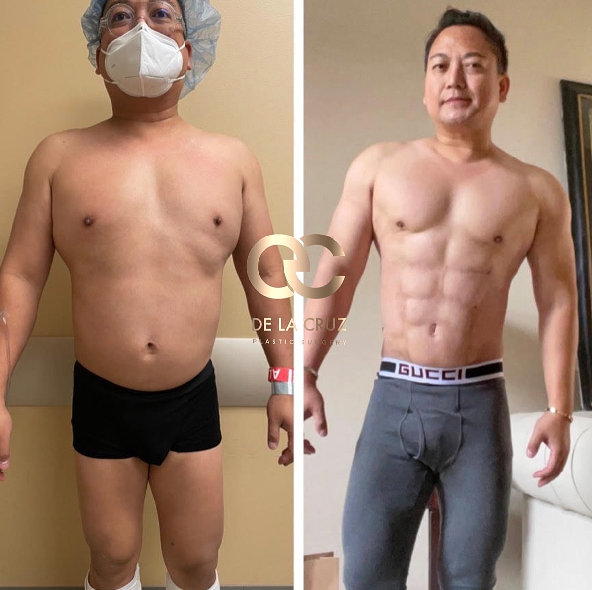 4d Vaser Liposuction For Men Before & After