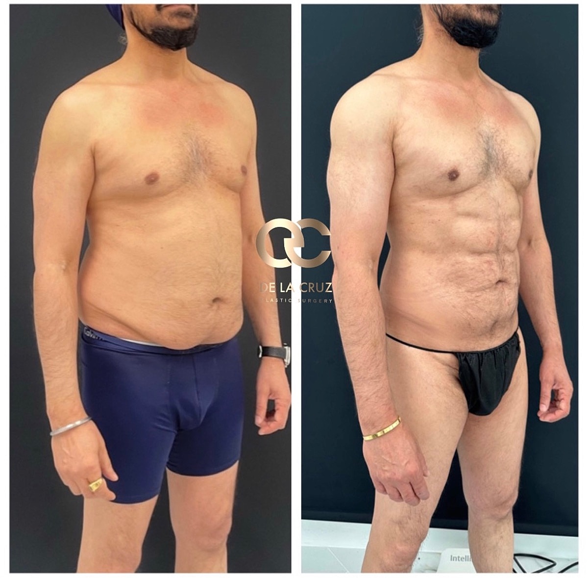 4d Vaser Liposuction For Men Before & After