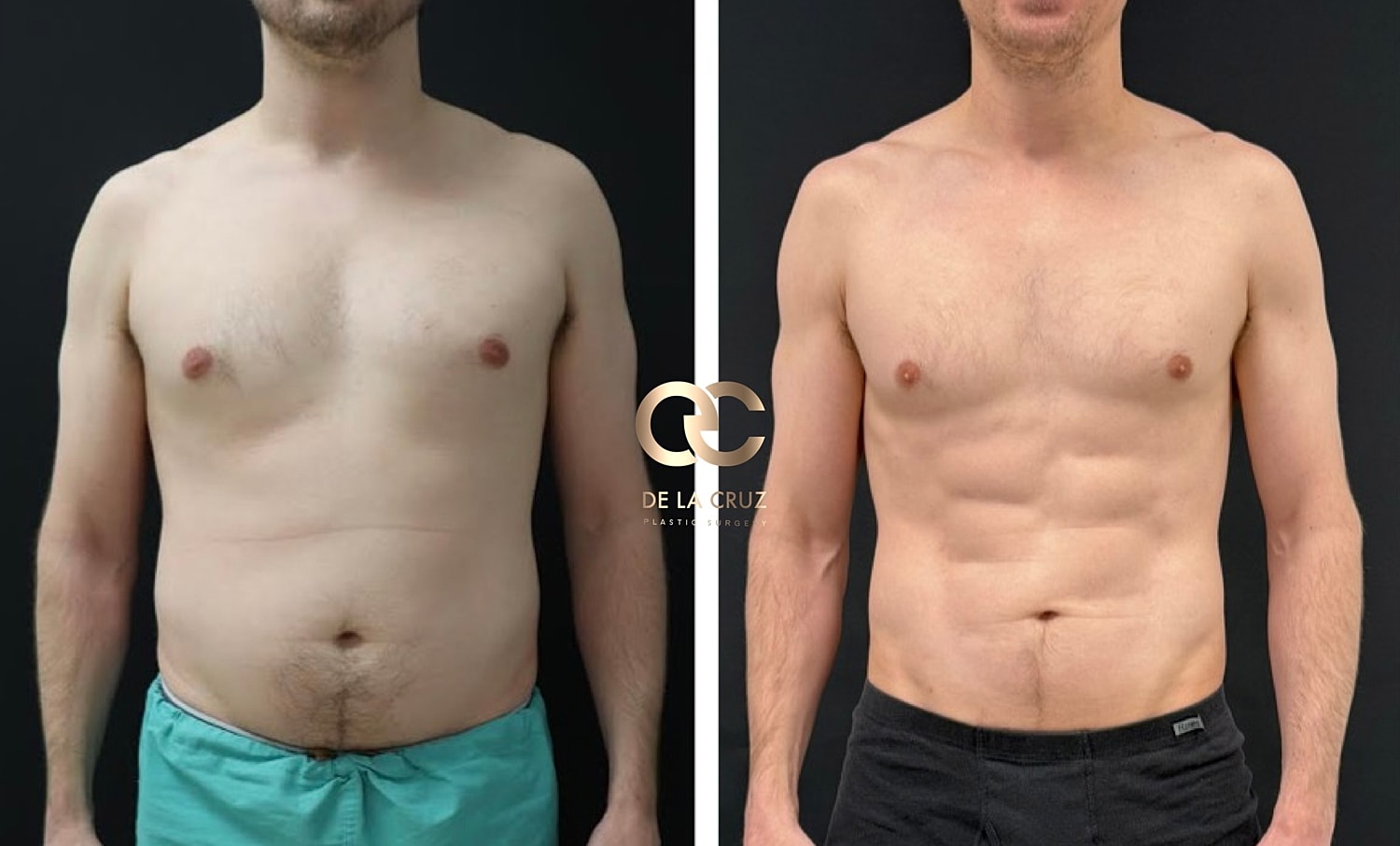 Before and after body transformation comparison.