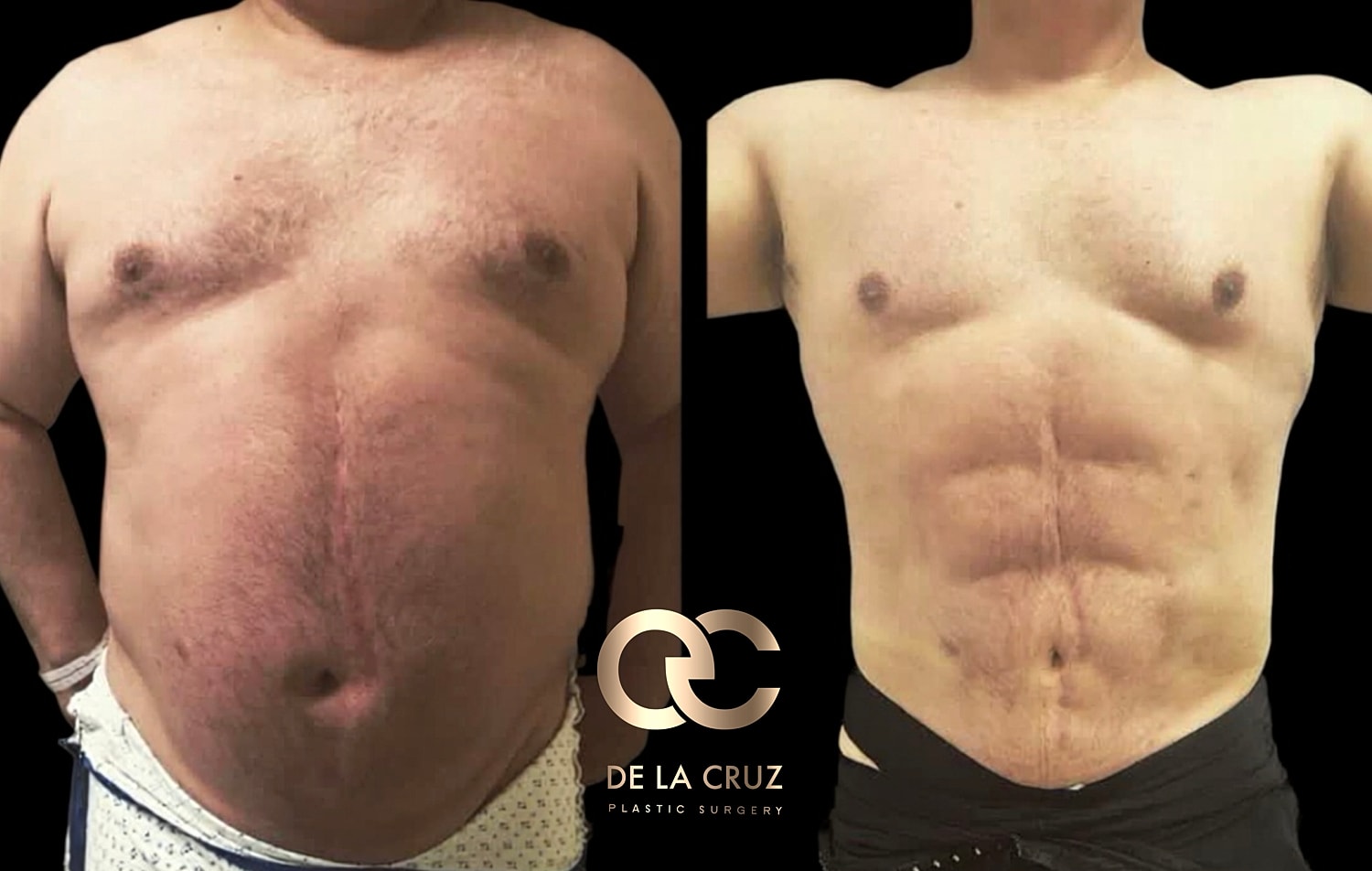 Before and after plastic surgery transformation image.