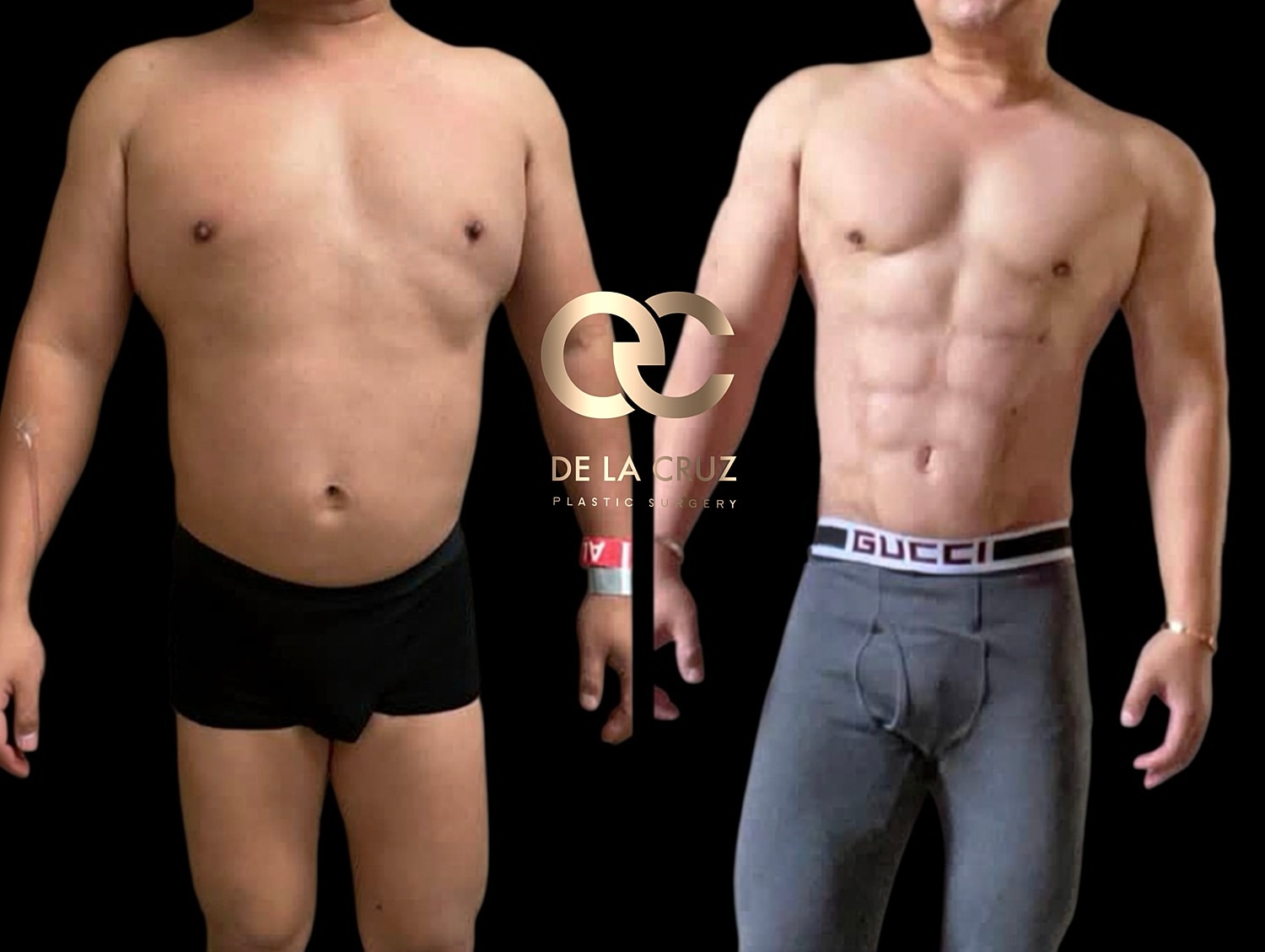 Before and after plastic surgery transformation.