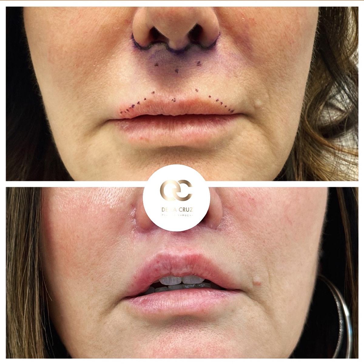Upper Lip Lift Before & After