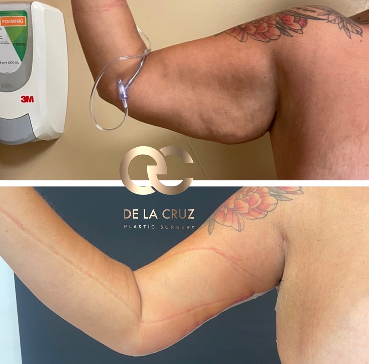 Brachioplasty Before & After