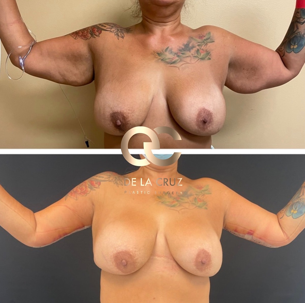 Brachioplasty Before & After
