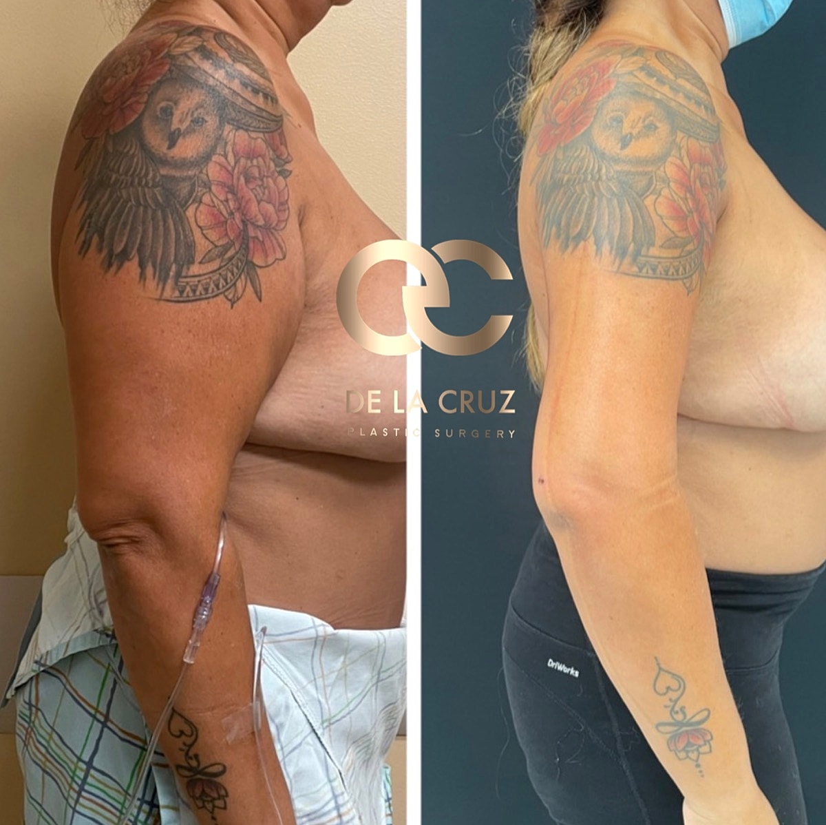 Brachioplasty Before & After