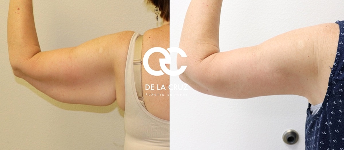 Brachioplasty Before & After