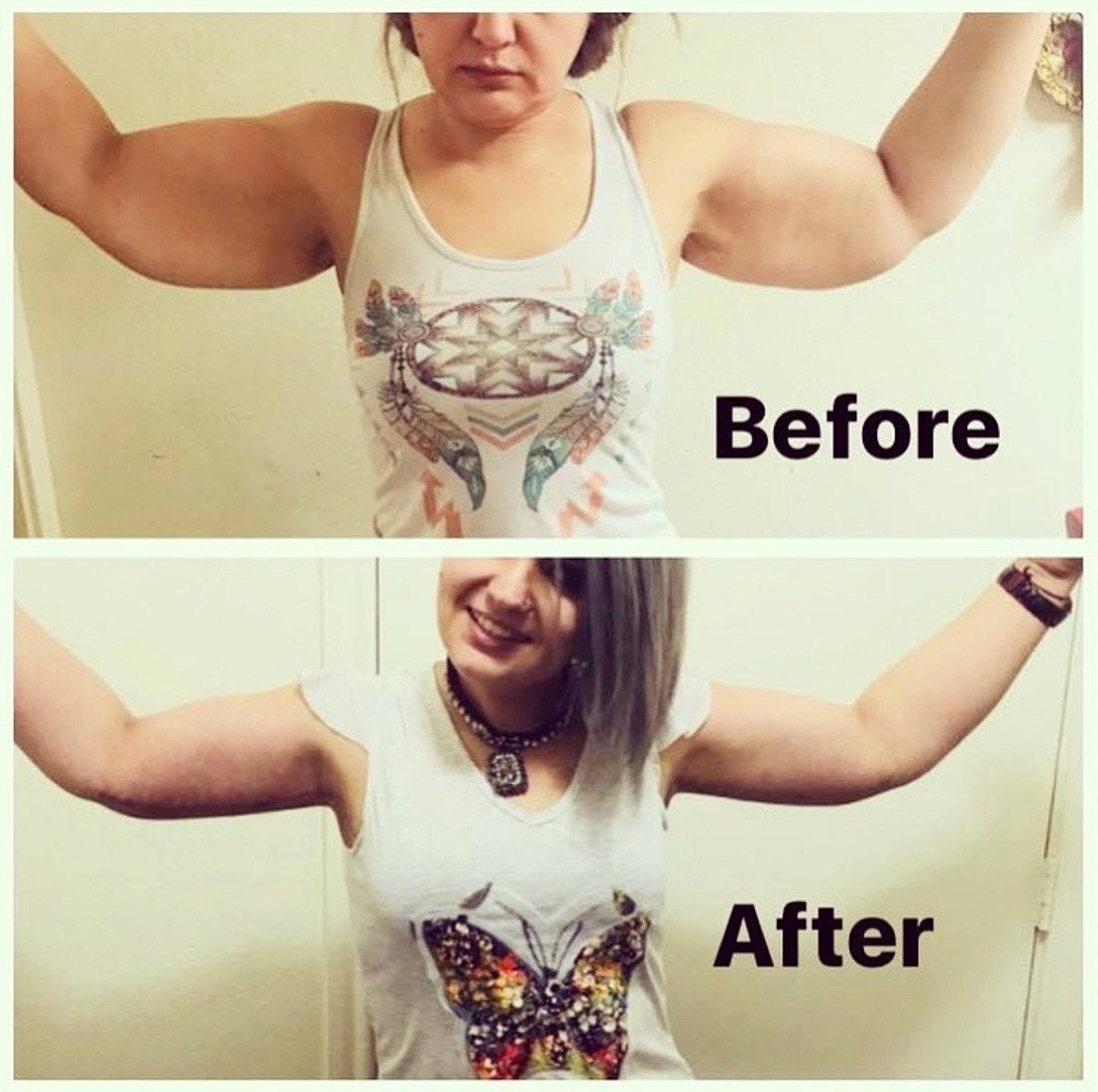 Brachioplasty Before & After