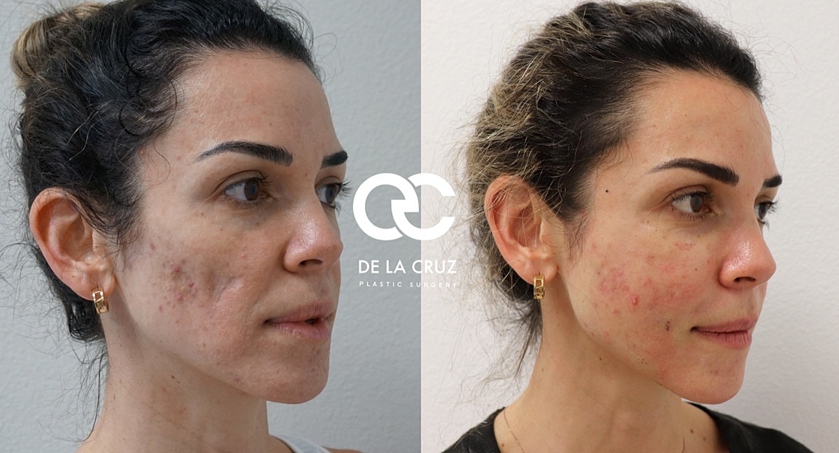 Sculptra Before & After