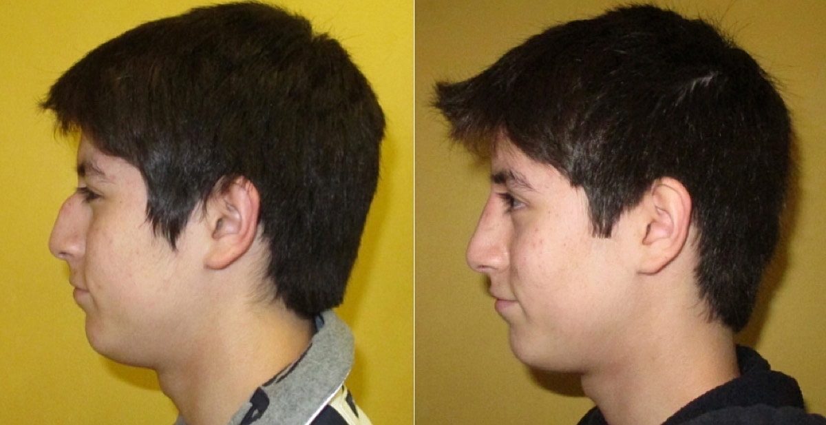 Rhinoplasty Before & After