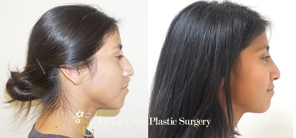 Rhinoplasty Before & After