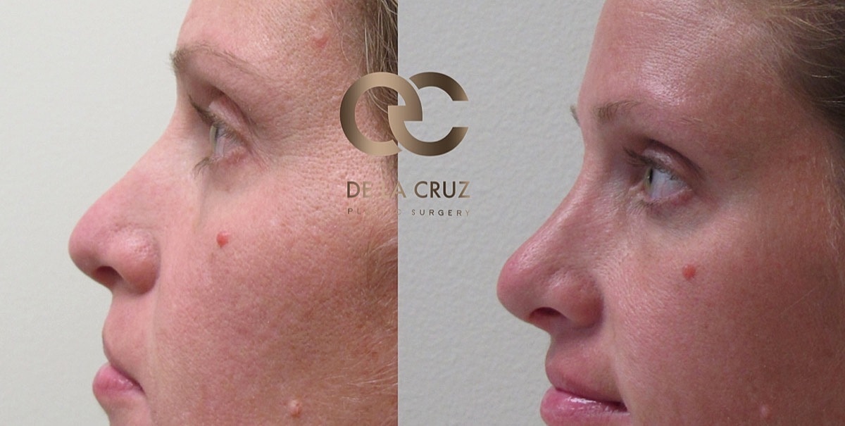 Rhinoplasty Before & After