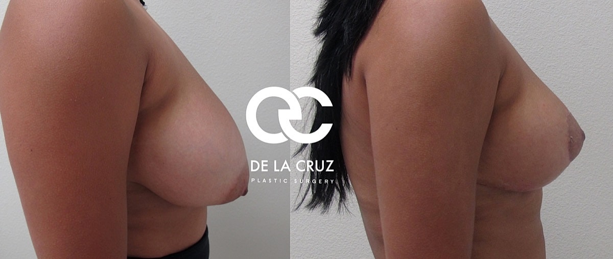 Breast Lift Before & After