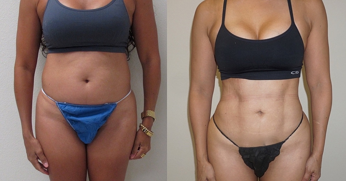 4d Vaser Liposuction Before & After