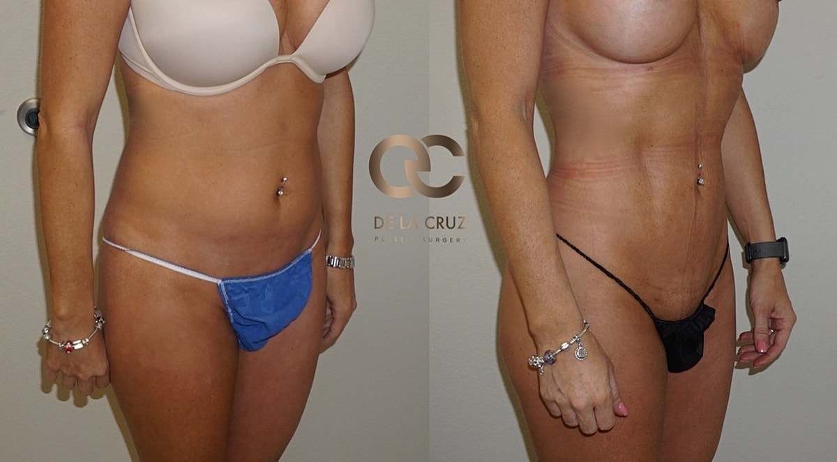 4d Vaser Liposuction Before & After