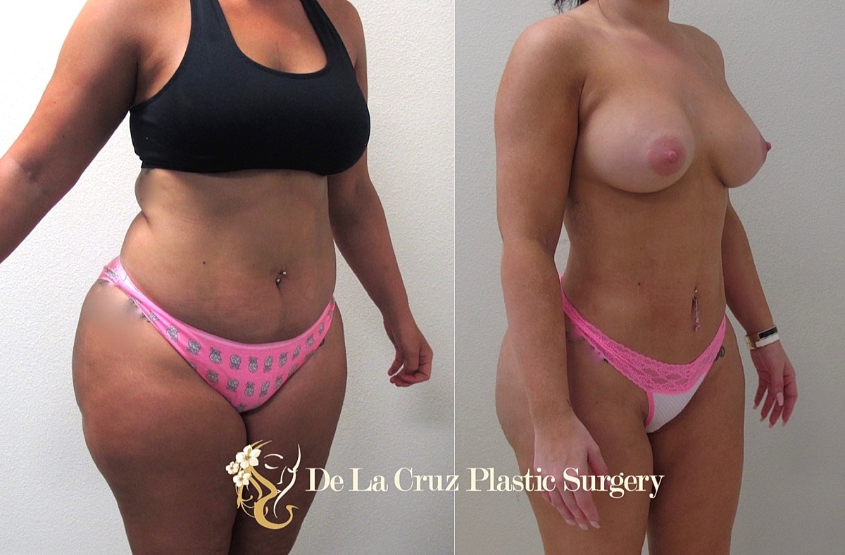 4d Vaser Liposuction Before & After