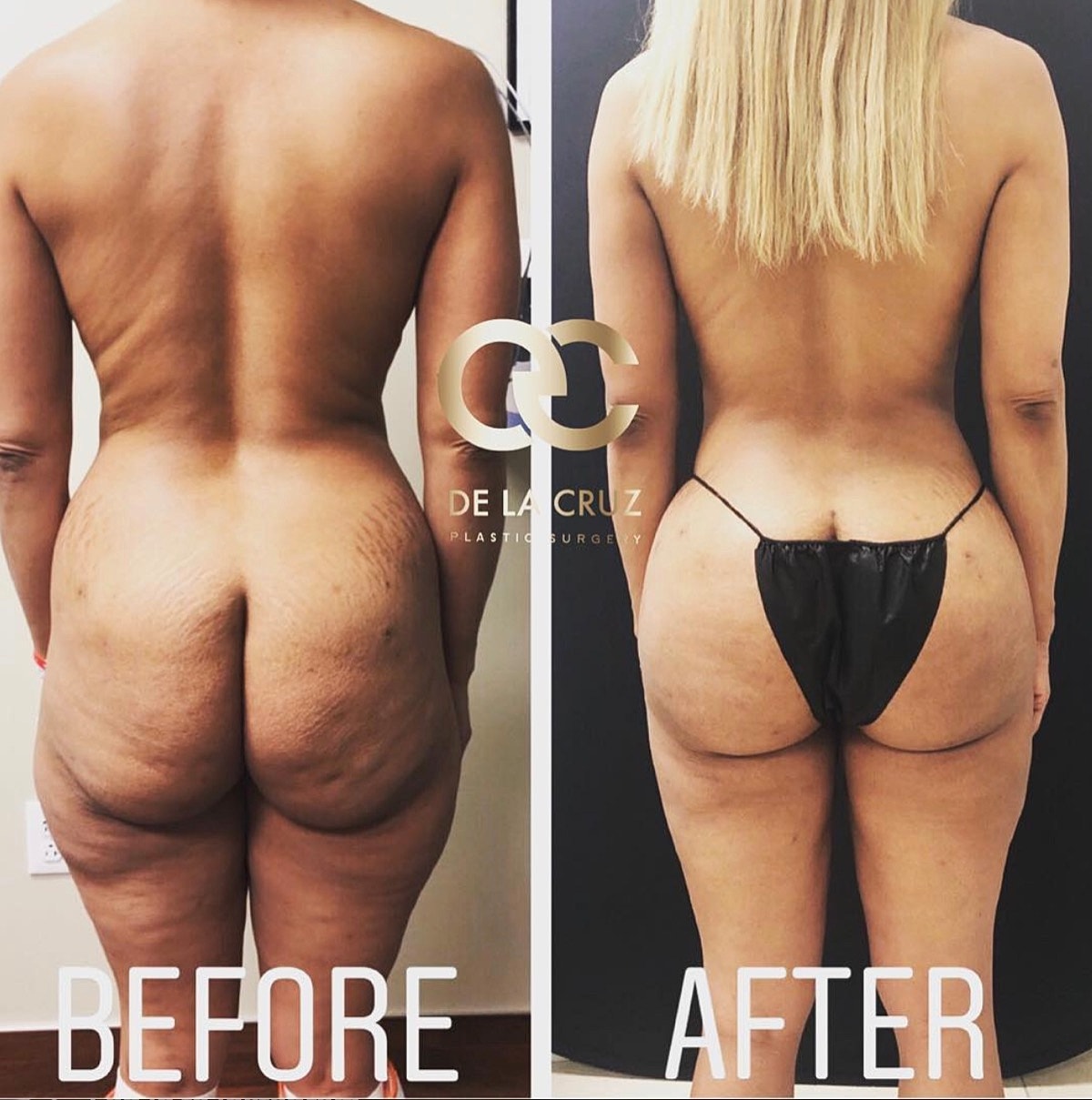 4d Vaser Liposuction Before & After