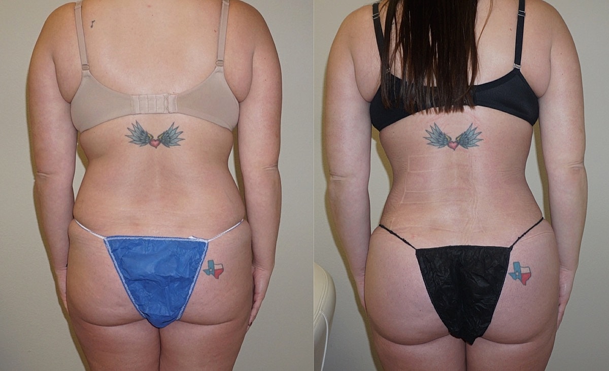 4d Vaser Liposuction Before & After