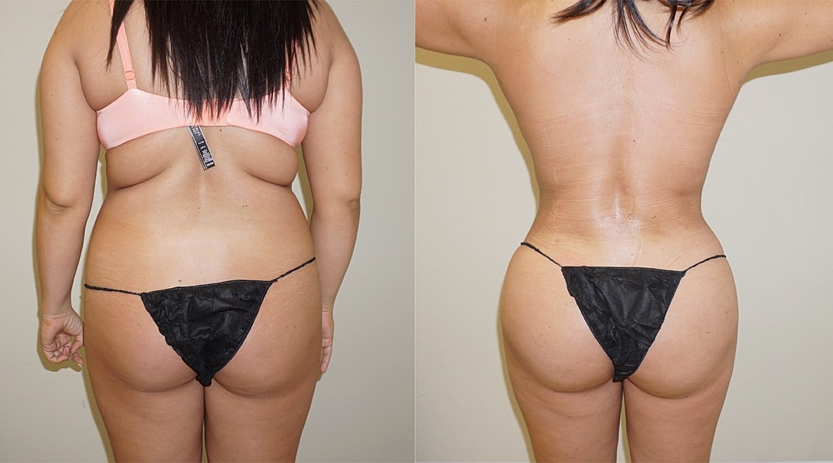 4d Vaser Liposuction Before & After