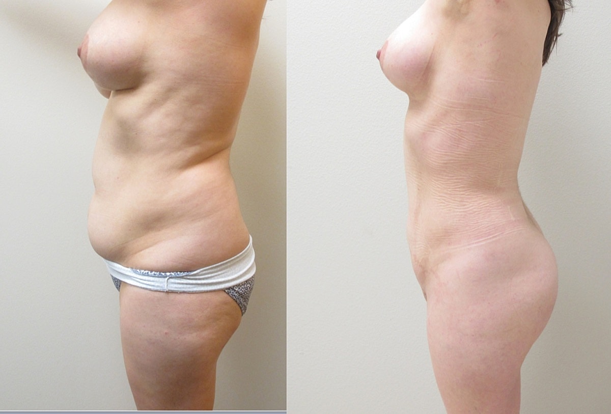 4d Vaser Liposuction Before & After