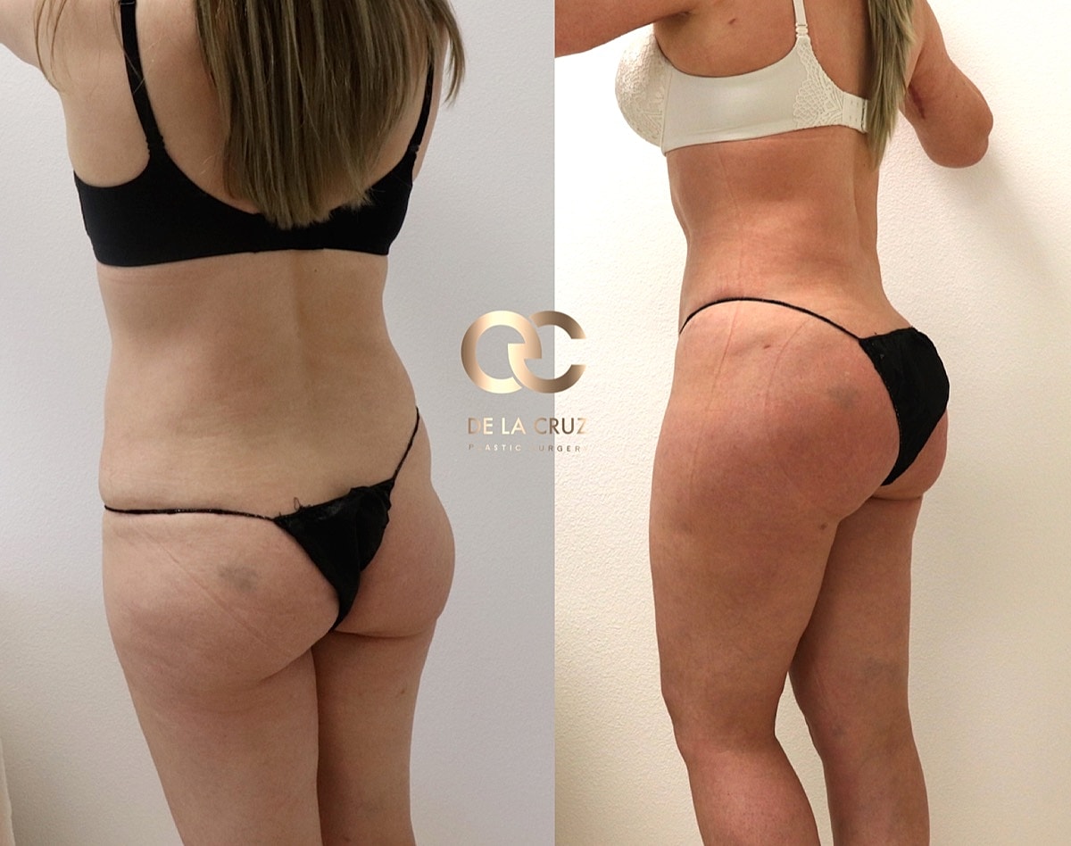 4d Vaser Liposuction Before & After