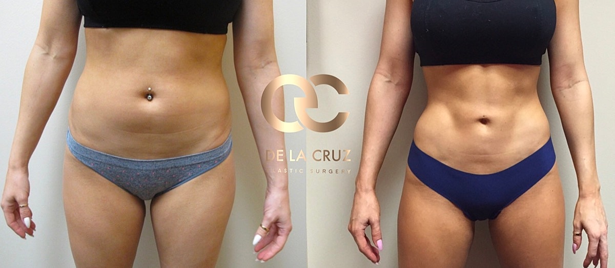 4d Vaser Liposuction Before & After