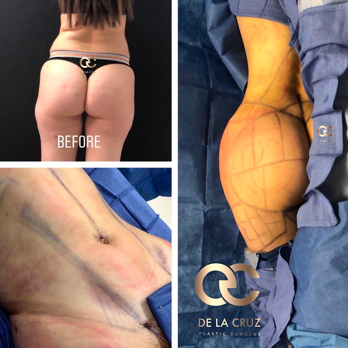 4d Vaser Liposuction Before & After