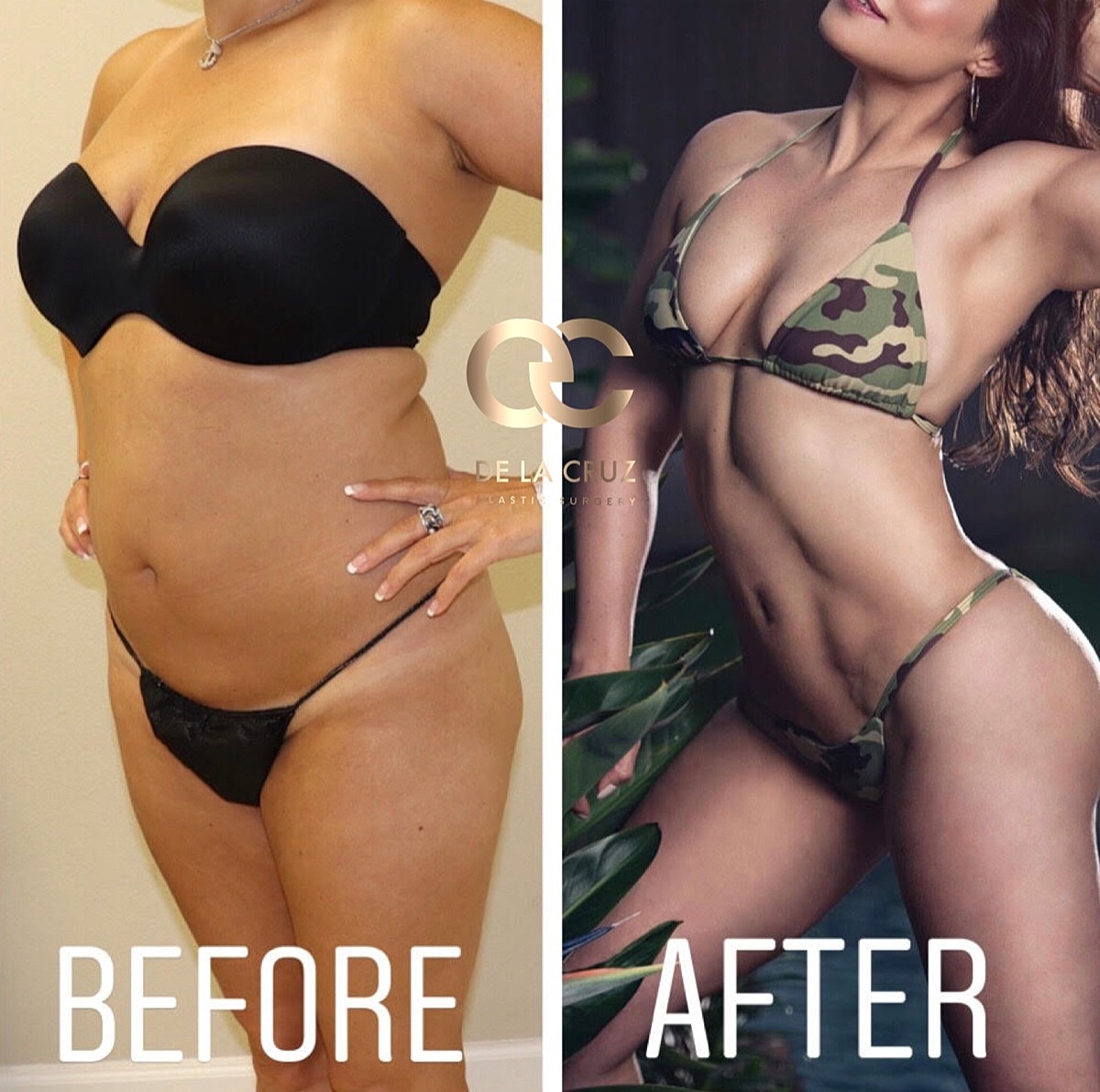 4d Vaser Liposuction Before & After